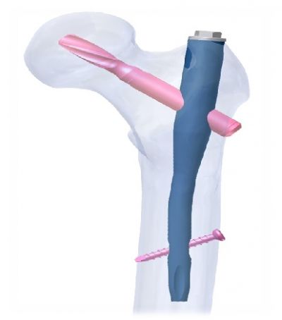 ATLAS™ PFNA Nailing System е имплант за лечение на нестабилни трохантерни фрактури на бедрената кост  
