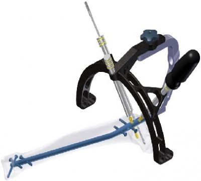 HIMALAYA™ Expert Tibia Nailing System   