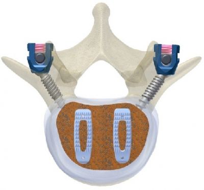 JUPITERTM PLIF PEEK Cage 