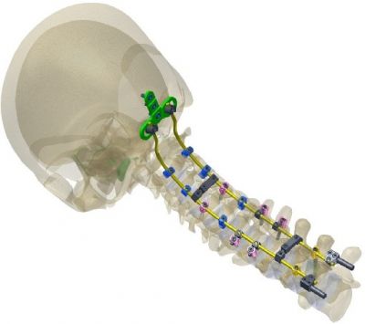 Система PLUTO™ Occipito-Cervical Fusion System 